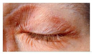 eczema under eye causing skin folds and wrinkles
